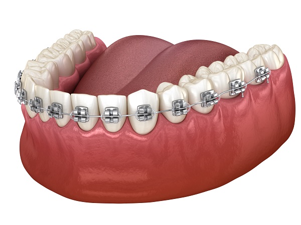 Orthodontic Bracket - an overview