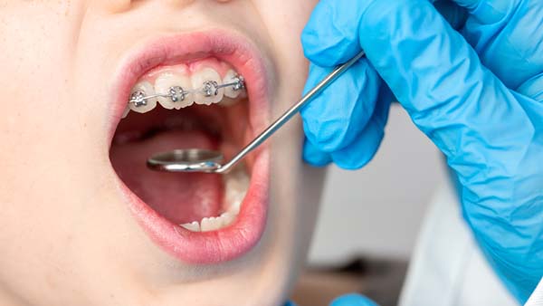 What To Ask Your General Dentist About Ceramic Braces For Teeth Straigtening