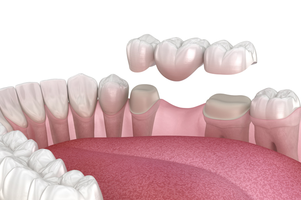 Dental Bridge Options: How Bridges Replace Missing Teeth And Support Bite Function