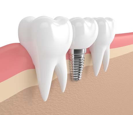 Dental Implant Camas, WA