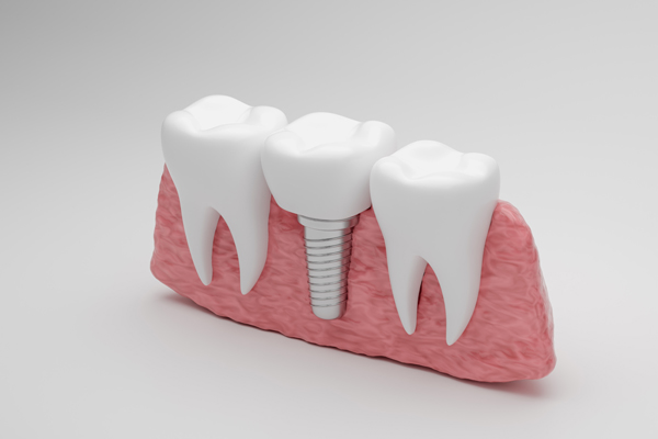 Understanding The Procedure For Dental Implants