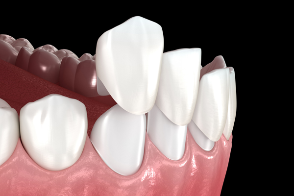 Dental Veneers Vs  Dentures: What Is The Difference?