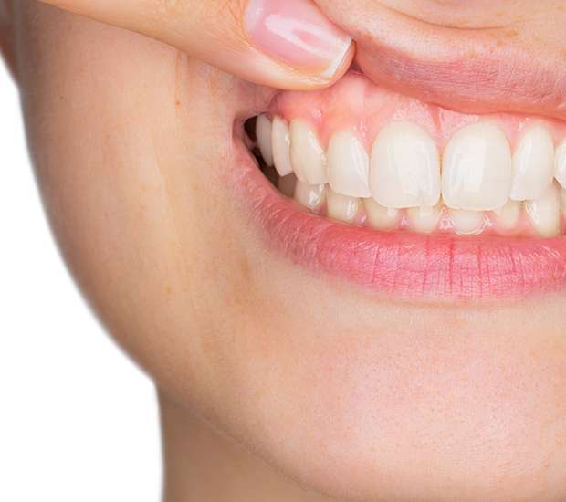 Camas Gum Disease
